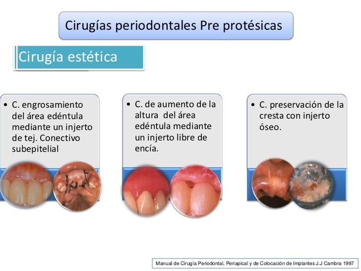 cirugia periodontal preprotesica